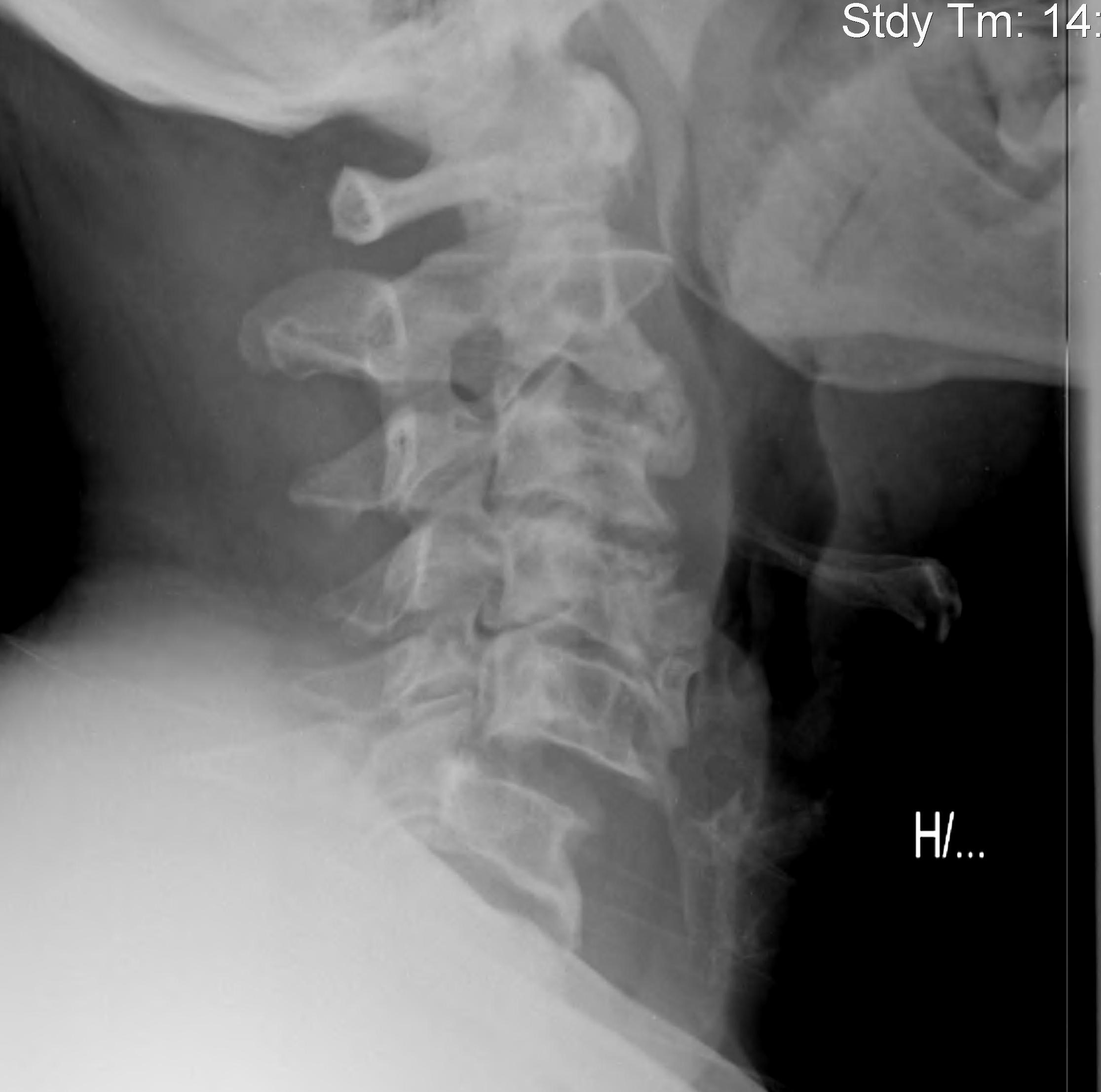 C56 Unilateral Facet Dislocation